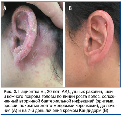 Рис. 2. Пациентка В., 20 лет, АКД ушных раковин, шеи и кожного покрова головы по линии роста волос, ослож- ненный вторичной бактериальной инфекцией (эритема, эрозии, покрытые желто-медовыми корочками), до лечения (А) и на 7-й день лечения кремом Кандидерм Рис. 2. Пациентка В., 20 лет, АКД ушных раковин, шеи и кожного покрова головы по линии роста волос, ослож- ненный вторичной бактериальной инфекцией (эритема, эрозии, покрытые желто-медовыми корочками), до лечения (А) и на 7-й день лечения кремом Кандидерм