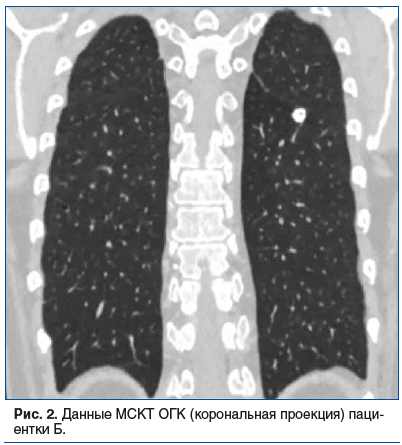 Рис. 2. Данные МСКТ ОГК (корональная проекция) пациентки Б.