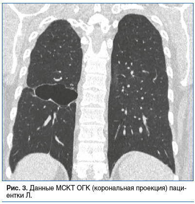 Рис. 3. Данные МСКТ ОГК (корональная проекция) пациентки Л.