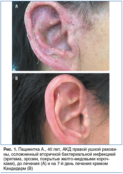 Рис. 1. Пациентка А., 40 лет, АКД правой ушной ракови- ны, осложненный вторичной бактериальной инфекцией (эритема, эрозии, покрытые желто-медовыми короч- ками), до лечения (А) и на 7-й день лечения кремом Кандидерм (В) Рис. 1. Пациентка А., 40 лет, АКД правой ушной ракови- ны, осложненный вторичной бактериальной инфекцией (эритема, эрозии, покрытые желто-медовыми короч- ками), до лечения (А) и на 7-й день лечения кремом Кандидерм (В)