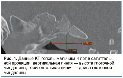Рис. 1. Данные КТ головы мальчика 4 лет в сагитталь- ной проекции: вертикальная линия — высота глоточной миндалины, горизонтальная линия — длина глоточной миндалины