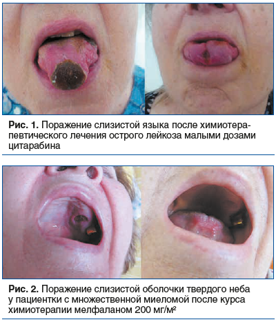 Рис. 1. Поражение слизистой языка после химиотера- певтического лечения острого лейкоза малыми дозами цитарабина Рис. 1. Поражение слизистой языка после химиотера- певтического лечения острого лейкоза малыми дозами цитарабина