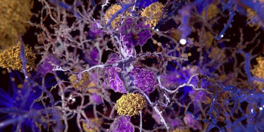 Nature Medicine: микроглия определяет, станет ли амилоид Альцгеймером или нет
