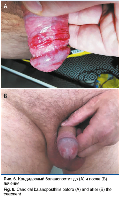 Рис. 6. Кандидозный баланопостит до (А) и после (B) лечения Fig. 6. Candidal balanoposthitis before (A) and after (B) the treatment Рис. 6. Кандидозный баланопостит до (А) и после (B) лечения Fig. 6. Candidal balanoposthitis before (A) and after (B) the treatment