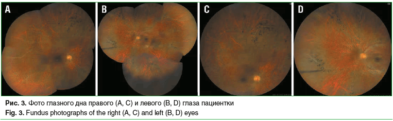 Рис. 3. Фото глазного дна правого (А, С) и левого (В, D) глаза пациентки Fig. 3. Fundus photographs of the right (A, C) and left (B, D) eyes Рис. 3. Фото глазного дна правого (А, С) и левого (В, D) глаза пациентки Fig. 3. Fundus photographs of the right (A, C) and left (B, D) eyes