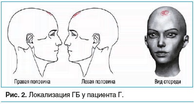 Рис. 2. Локализация ГБ у пациента Г.