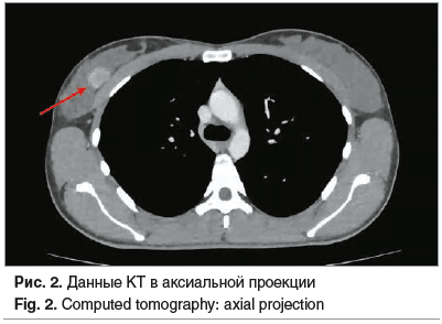 Рис. 2. Данные КТ в аксиальной проекции Fig. 2. Computed tomography: axial projection