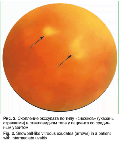 Рис. 2. Скопление экссудата по типу «снежков» (указаны стрелками) в стекловидном теле у пациента со средин- ным увеитом Fig. 2. Snowball-like vitreous exudates (arrows) in a patient with intermediate uveitis Рис. 2. Скопление экссудата по типу «снежков» (указаны стрелками) в стекловидном теле у пациента со средин- ным увеитом Fig. 2. Snowball-like vitreous exudates (arrows) in a patient with intermediate uveitis