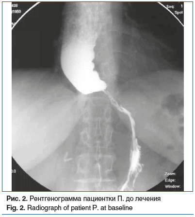 Рис. 2. Рентгенограмма пациентки П. до лечения Fig. 2. Radiograph of patient P. at baseline