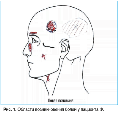 Рис. 1. Области возникновения болей у пациента Ф.