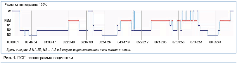 Рис. 1. ПСГ, гипнограмма пациентки