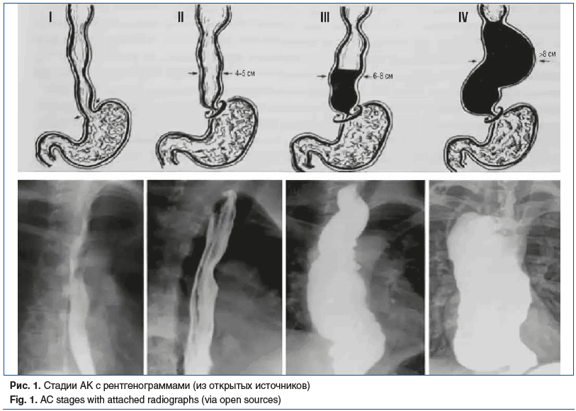 Рис. 1. Стадии АК с рентгенограммами (из открытых источников) Fig. 1. AC stages with attached radiographs (via open sources)