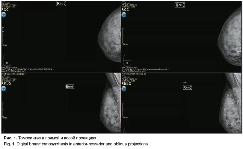 Рис. 1. Томосинтез в прямой и косой проекциях Fig. 1. Digital breast tomosynthesis in anterior-posterior and oblique projections