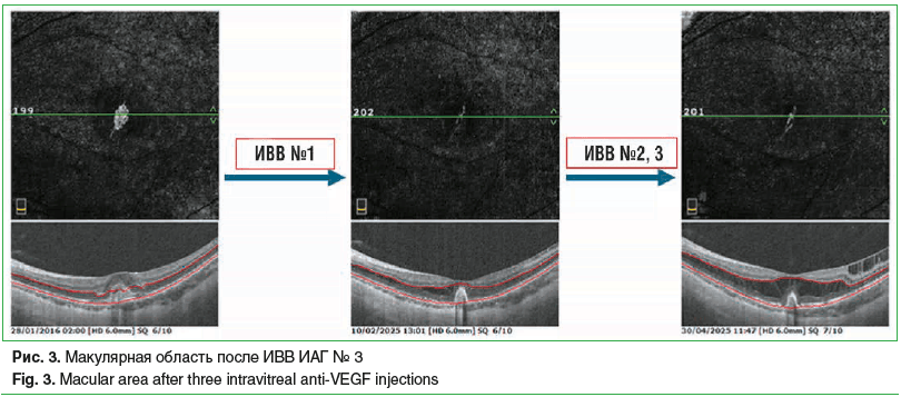 Рис. 3. Макулярная область после ИВВ ИАГ № 3 Fig. 3. Macular area after three intravitreal anti-VEGF injections