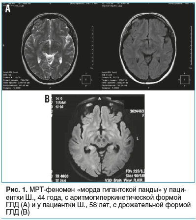 Рис. 1. МРТ-феномен «морда гигантской панды» у паци- ентки Ш., 44 года, с аритмогиперкинетической формой ГЛД (А) и у пациентки Ш., 58 лет, с дрожательной формой ГЛД (В)