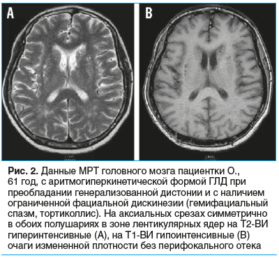 Рис. 2. Данные МРТ головного мозга пациентки О., 61 год, с аритмогиперкинетической формой ГЛД при преобладании генерализованной дистонии и с наличием ограниченной фациальной дискинезии (гемифациальный спазм, тортиколлис). На аксиальных срезах симметрично 