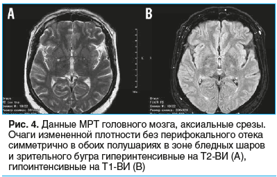 Рис. 4. Данные МРТ головного мозга, аксиальные срезы. Очаги измененной плотности без перифокального отека симметрично в обоих полушариях в зоне бледных шаров и зрительного бугра гиперинтенсивные на Т2-ВИ (A), гипоинтенсивные на Т1-ВИ (B)