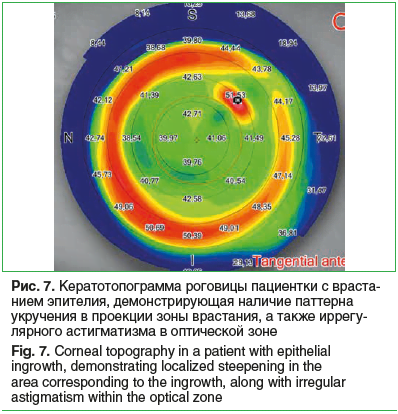 Рис. 7. Кератотопограмма роговицы пациентки с враста- нием эпителия, демонстрирующая наличие паттерна укручения в проекции зоны врастания, а также иррегу- лярного астигматизма в оптической зоне Fig. 7. Corneal topography in a patient with epithelial ingro