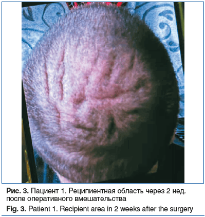 Рис. 3. Пациент 1. Реципиентная область через 2 нед. после оперативного вмешательства Fig. 3. Patient 1. Recipient area in 2 weeks after the surgery