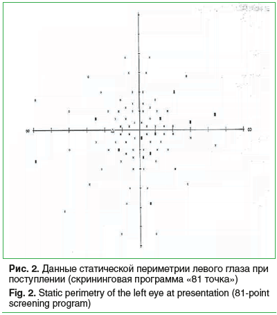 Рис. 2. Данные статической периметрии левого глаза при поступлении (скрининговая программа «81 точка») Fig. 2. Static perimetry of the left eye at presentation (81-point screening program) Рис. 2. Данные статической периметрии левого глаза при поступлении (скрининговая программа «81 точка») Fig. 2. Static perimetry of the left eye at presentation (81-point screening program)