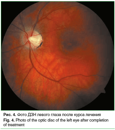 Рис. 4. Фото ДЗН левого глаза после курса лечения Fig. 4. Photo of the optic disc of the left eye after completion of treatment Рис. 4. Фото ДЗН левого глаза после курса лечения Fig. 4. Photo of the optic disc of the left eye after completion of treatment