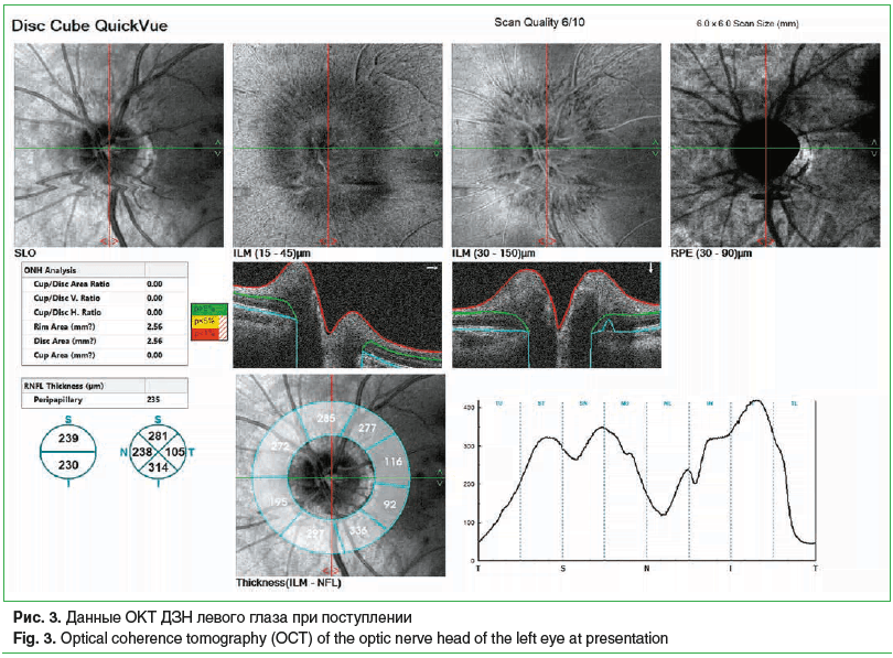 Рис. 3. Данные ОКТ ДЗН левого глаза при поступлении Fig. 3. Optical coherence tomography (OCT) of the optic nerve head of the left eye at presentation Рис. 3. Данные ОКТ ДЗН левого глаза при поступлении Fig. 3. Optical coherence tomography (OCT) of the optic nerve head of the left eye at presentation