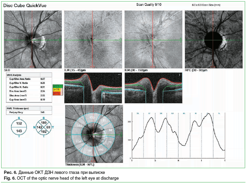 Рис. 6. Данные ОКТ ДЗН левого глаза при выписке Fig. 6. OCT of the optic nerve head of the left eye at discharge Рис. 6. Данные ОКТ ДЗН левого глаза при выписке Fig. 6. OCT of the optic nerve head of the left eye at discharge