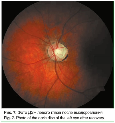 Рис. 7. Фото ДЗН левого глаза после выздоровления Fig. 7. Photo of the optic disc of the left eye after recovery Рис. 7. Фото ДЗН левого глаза после выздоровления Fig. 7. Photo of the optic disc of the left eye after recovery