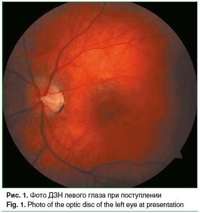 Рис. 1. Фото ДЗН левого глаза при поступлении Fig. 1. Photo of the optic disc of the left eye at presentation Рис. 1. Фото ДЗН левого глаза при поступлении Fig. 1. Photo of the optic disc of the left eye at presentation